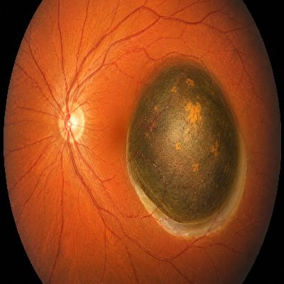 Uveal Melanoma & Intraocular Tumours